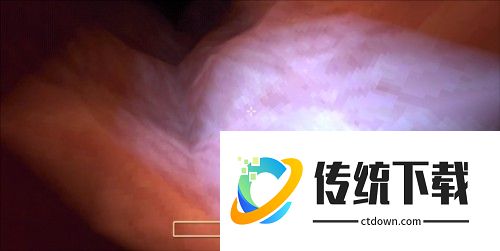 大肠的复仇